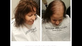 פתרון לשיער דליל והתקרחות בטכניקה חדשנית-nissan porazany