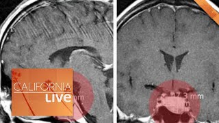 The Supplement That Helped a Doctor With His Brain Tumor  | California Live | NBCLA