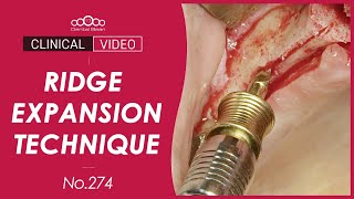 Ridge expansion with simultaneous implant placement [Dr. Jeon Inseong]