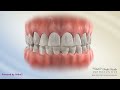 damon posterior crossbite orthodontic treatment