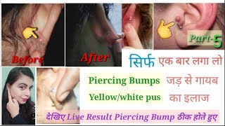 Piercing bumps गायब करने का आसान व घरेलू उपाय ll Home remedies for piercing bumps ll*Live Result* ll