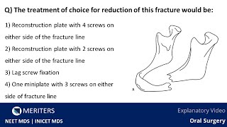 NEET MDS | INICET - Oral Surgery - Middle Third Fractures | Explanatory Video | MERITERS