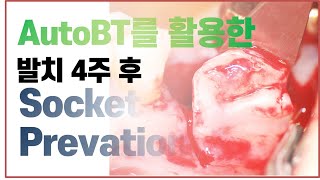 [한국치아은행] #2. 발치 4주 후 socket preservation