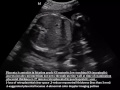 CASE 202 PLACENTA MARGINALIS INCRETA