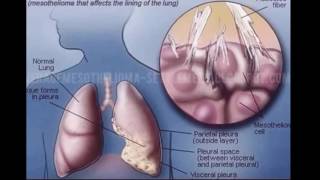 Washington mesothelioma attorney