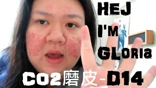 救救凹洞臉2「Co2二氧化碳磨皮-第14天」 CO2 Laser resurfacing-day14