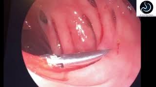 Colonic Diverticular Bleeding - hemostasis with hemoclips.