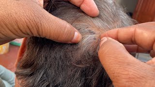 #nitspicking  wife removed husband lices super video || long hair find lice and remove💯part13👀