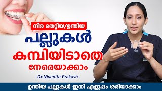 ഉന്തിയ പല്ലുകൾ ഇനി എളുപ്പം നേരയാകാം കമ്പിയിടാതെ / Clear Aligners for Teeth / Elite Dental Studio