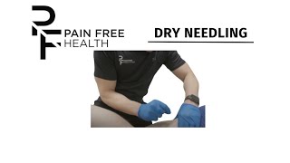 Intramuscular Stimulation (IMS) Dry Needling Treatments