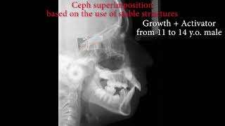 ❤️🔥 Ceph Superimposition based on the use of stable structures on a computer. (before AI)
