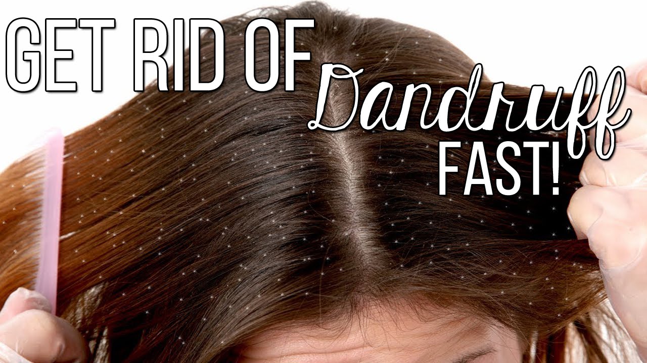 How To Get Rid Of Dandruff FAST!! Only 2 Ingredients! Highly Effective ...