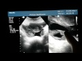 Ruptured Hemorrhagic Cyst Ultrasound