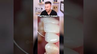 How to Get Veneers That DON’T Ruin Your Real Teeth!