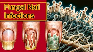 Understanding Onychomycosis: Nail Fungal Infection Treatment