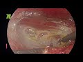 Laparoscopic e-TEP TAR (Posterior component separation)for Recurrent Incisional Hernia