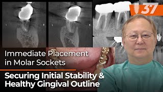 Immediate Placement in Molar Sockets ⎪ Securing Initial Stability \u0026 Healthy Gingival Outline