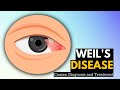 Weil's Disease: Causes, Symptoms And Treatment