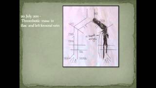 Chondromyxoid fibroma of 4th lumbar vertebral body