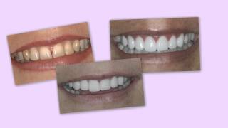 Temporary Veneers as a \