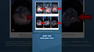 Why Finasteride Needs MORE Time to Work ⏰