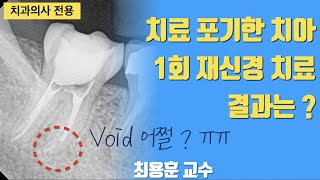 기존 방식으로 실패한 치아의 1회 재신경 치료 결과 #판교최용훈치과