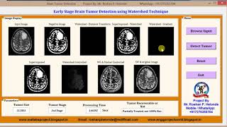Early Brain tumor Detection using Watershed matlab project source code