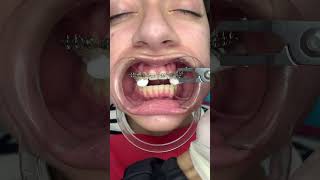 🔥Ni modo , ahora vamos quitarlos para comenzar nuevamente el tratamiento de los BRACKETS 😬🔥