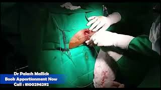 Laser Surgery By Prof Dr Palash Mallick #pilesdoctor #fistulainano #pileslasersurgery