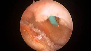 Arthroscopic release of the psoas muscle