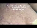 micro sclerotherapy for spider veins