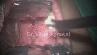 Coblation tonsillectomy right side in 6yr by Dr Vikas agrawal