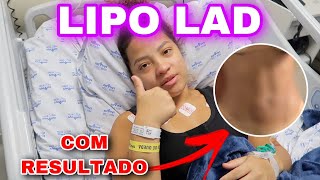 MINHA LIPO LAD - MOSTREI A REALIDADE