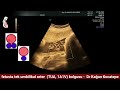 Single umbilical artery - SUA in the fetus. How is it detected, is it harmful to the baby?