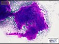 EUS FNA GIST (Epithelioid and Spindle cell)