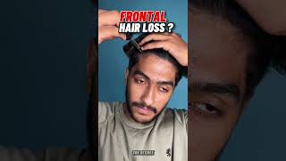 നെറ്റി കയറ്റത്തിനും ഉള്ളു കുറവിനും🔥😱Treatment For Frontal Hair loss And Balding #shorts