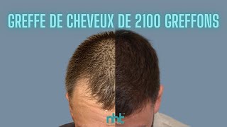 Greffe capillaire de 2100 greffons : Résultats avant/après