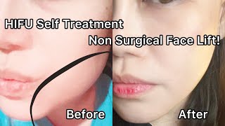 Non Surgical Face Lift Experience - SELF TREATMENT - mini Hifu