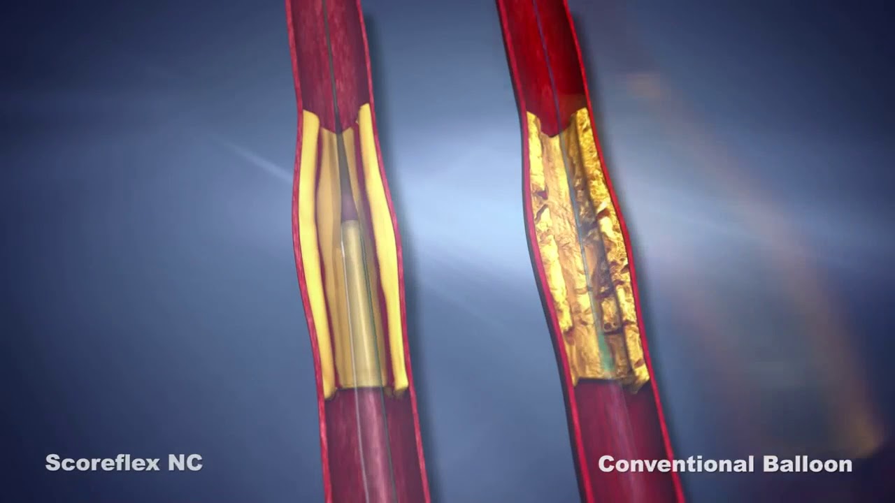 Scoreflex Nc Baloon Youtube