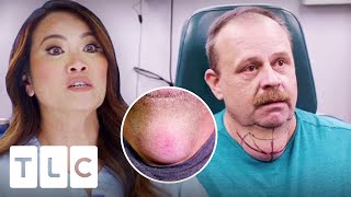 Dr Lee Is Scared To Operate On Patient Who Could Get Paralysed | Dr. Pimple Popper: This Is Zit