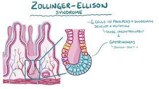 zollinger Ellison syndrome