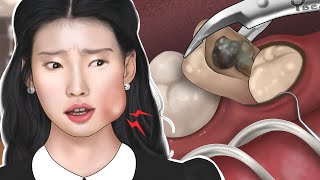 ASMR 사랑니 3초 컷 | Impacted Wisdom Tooth Extraction Removal | Dental Care Animation | YBeauty