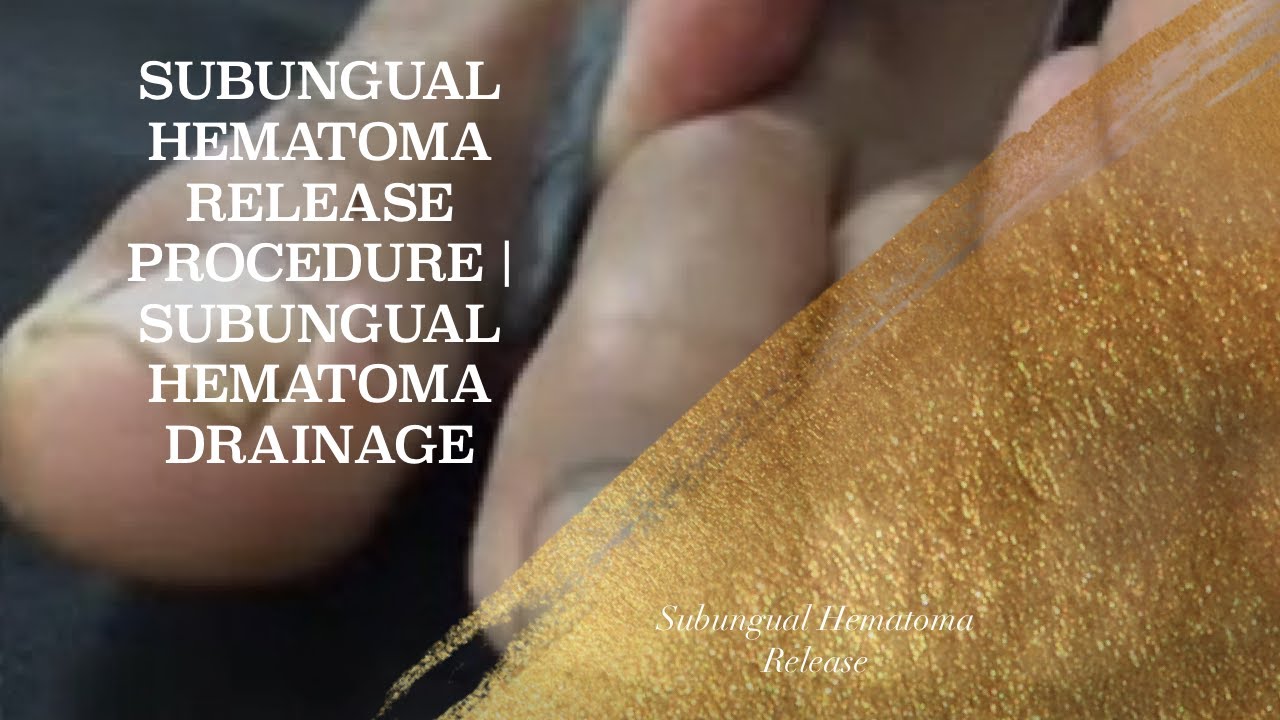 SUBUNGUAL HEMATOMA RELEASE PROCEDURE | SUBUNGUAL HEMATOMA DRAINAGE ...