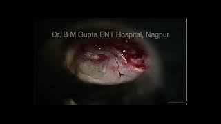 laser stapedectomy by Dr B M Gupta