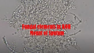 Fungal elements in KOH mount of Sputum sample