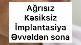 Ağrısız kəsiksiz implant və implantüstü diş əvvəldən sona