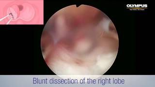 Transurethral Enucleation of the Prostate with Bipolar (TUEB)