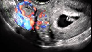 Ultrasound in Obstetrics \u0026 Gynecology: A Practical Approach - Clip 13.1