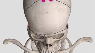 Bifrontal decompressive craniectomy: bony cuts