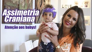 CURIOSIDADES SOBRE ASSIMETRIA CRANIANA! - Cuidado com os Babys